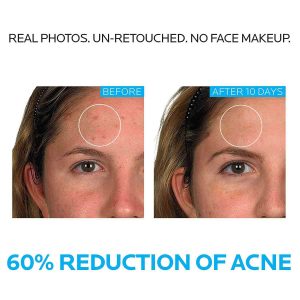 LA Roche-Posay 3 Step Acne Routine