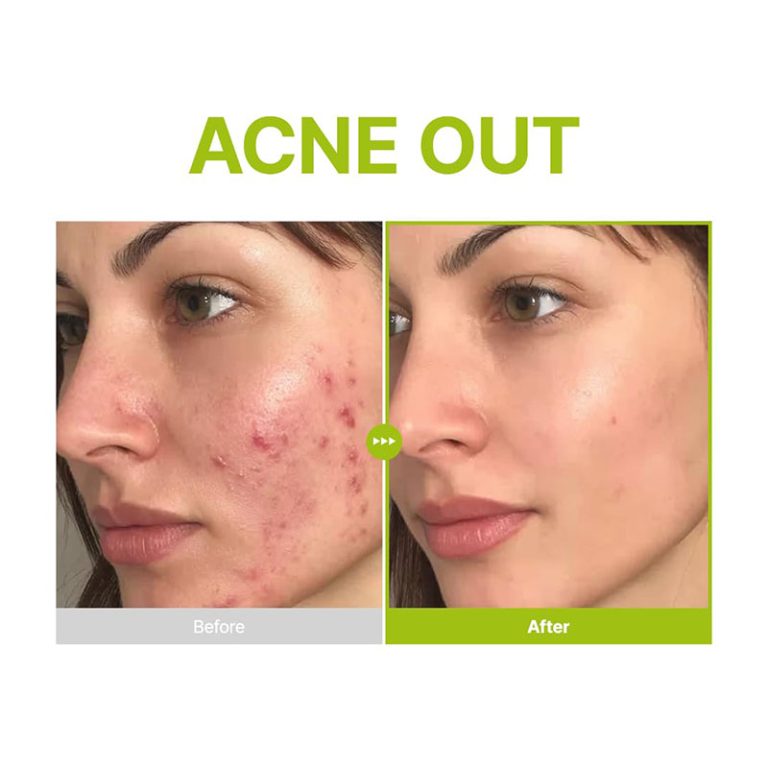 Purito Seoul Azelaic Acid 10 Kojic Azulene Serum 30ml